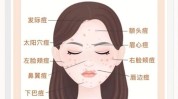 这份粉刺最有效祛痘攻略方法(粉刺祛痘这份攻略提取物)