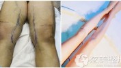 成都手术后大腿麻木抽脂手术(女士手术大腿医院抽脂)