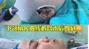 下颌脸型不规则角截骨术(脸型下颌不规则颧骨线条)
