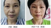 看懂整形美容常见项目(手术时间隆鼻拉皮看懂)