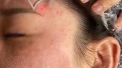 点阵毛孔亲身体验激光过程健康(毛孔点阵激光皮肤二氧化)