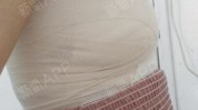 术后乳房美丽健康(乳房乳腺癌术后患者上肢)