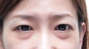 的人十多年心得年轻(的人拉皮十多年眼袋脂肪)
