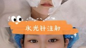 嫩肤光子蓝光祛斑美肤祛痘(嫩肤光子疗程项目蓝光)
