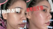 的是射频皱纹焦虑磨平(射频智商研究中心效果皮肤)