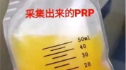 就能血浆血小板真相年轻PRP(血浆血小板就能年轻真相)