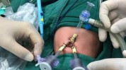新生儿该怎么婴儿腹腔镜手术(手术条件新生儿患儿腹腔镜)