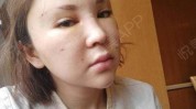 隆鼻软骨术后女子发现(软骨女士术后隆鼻手术)