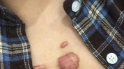 的人瘢痕能做能不体质美容手术(瘢痕体质的人美容手术能做)