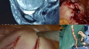 腹腔子宫肌瘤最具影响力港城女性镜下(腹腔子宫肌瘤技术最具影响力镜下)