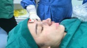 门诊部吉林市隆鼻肋骨术后噩梦(吉林市门诊部隆鼻医疗美容孙女)
