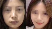 面部脂肪新趋势(脂肪面部效果患者术后)