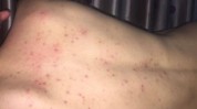 天全过来人后背痘痘实战大片(痘痘天全后背祛痘过来人)