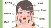 全攻略战痘策术法(全攻略皮肤痤疮红光蓝光)