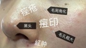 还在能让痤疮粗大毛孔换肤(水杨酸换肤痤疮粗大皮肤)
