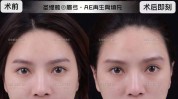 魅力项目明星丰眉弓(手术面部方式医生立体感)