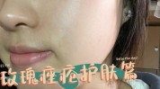 脸颊咋办出油多毛(痤疮脸颊护肤品孕妇出油)