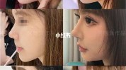 实战项目句鼻部(鼻子面部隆鼻立体感两眼)
