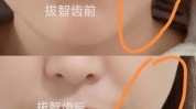 智齿月半瘦脸最快女孩方法(智齿瘦脸月半方法最快)