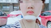 两次长沙下巴遭拒手术女子(下巴长沙医院女士歪斜)
