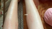 给你全身夏天(给你全身夏天毛发毛囊)