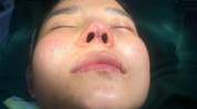 整形手术有哪些(鼻尖软骨手术鼻孔鼻头)