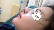 鼻子要花多少钱(万元鼻子手术软骨方式)