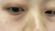 锦囊眼部眼睛(黑眼圈眼部眼睛锦囊皮肤)