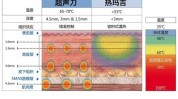 光子超声波详解项目热玛吉(光子超声波项目详解皮肤)