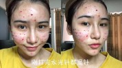 术后多久(术后针眼淡妆激光水光)