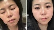 这件事都来姐妹建议项目抗老选医美(项目这件事都来皮肤姐妹)
