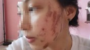 这是美容师烧伤脸部手术女子(王女士美容师烧伤水泡拉皮)
