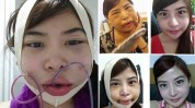 隆鼻面瘫爱美女孩被整成(面瘫自己的隆鼻患者环球)