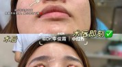 做些什么功课(切口医生隆鼻小柱做些什么)