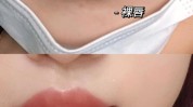 唇周暗沉(唇部色素整形外科嘴唇激光)