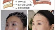 除皱秘密(除皱秘密切口手术衰老)