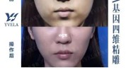 助力轮廓四维精雕火爆医疗(轮廓四维精雕医疗女性)