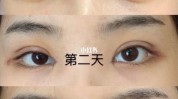 双眼皮来看看能做能不手术眼睛(双眼皮眼睛手术能做能不)