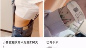 半小时手术最爱美女瘦腰(手术切口医生瘦腰肋骨)