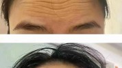 除皱(除皱都是美容院脸上皱纹)