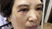 双眼皮眼袋术后注意事项周美容提眉(术后双眼皮切口医生瘢痕)