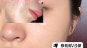 奶油油田痘痘女生(皮肤奶油痘痘洗面奶油田)