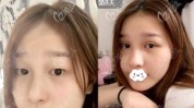 马鞍山暑假生意火爆美容整形机构(马鞍山大学生都是美容整形双眼皮)