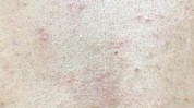 后背祛痘男生效果(后背祛痘效果男生果酸)