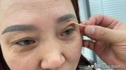 细节带你眼睛医生(医生细节双眼皮带你松弛)