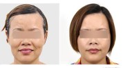拉皮很多人榜首最可怕后悔手术(拉皮手术后悔很多人最可怕)