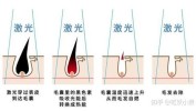 仪器比较好哪种原理(毛囊仪器原理激光比较好)