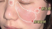 面部泛红几件事建议女人(泛红皮肤面部建议几件事)