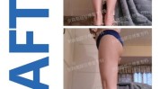 万元塑性凹凸不平腿上要花抽脂(凹凸不平万元塑性抽脂腿上)