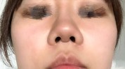 这么做显眼鼻子(鼻子软骨小柱同济鼻尖)